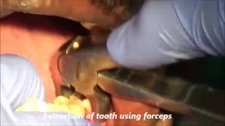 Periapical Periodontitis lower molar extraction [upl. by Eceirahs]