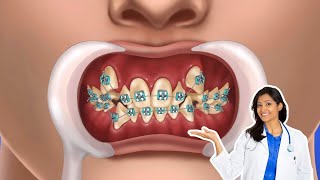 How Braces Work Elements of the orthodontic treatment ASMR [upl. by Leclair]