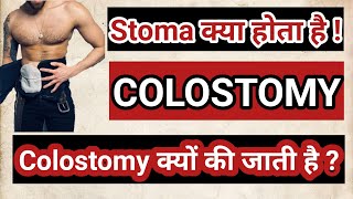 colostomy  colostomy care in hindi  colostomy bag  colostomy care  stoma bag [upl. by Ecneps]