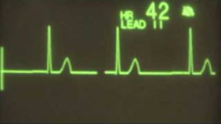 Junctional Bradycardia  ECG Training [upl. by Gilda]