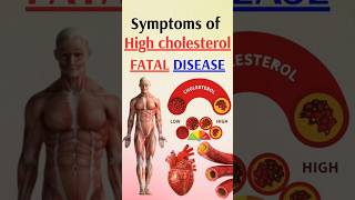 Symptoms of high cholesterol  fatal disease [upl. by Winters]