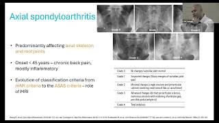 SPONDYLOARTHRITIS  APPROACH AND MANAGEMENT  DR ASHISH J MATHEW RHEUMATOLOGY [upl. by Nnylylloh606]