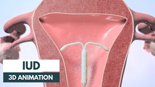 How does an IUD work  3D animation [upl. by Nerehs291]