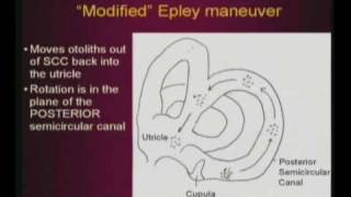 Epley Maneuver [upl. by Schilit401]