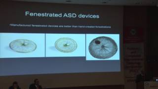 Shakeel A Qureshi ASD closure with miscellaneous devices advantages and disadvantages [upl. by Ann-Marie]