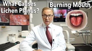 Lichen Planus  Burning Mouth Symptoms  Causes  Treatment [upl. by Elsbeth]