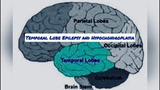 Temporal lobe epilepsy and hypochondroplasia [upl. by Bradford]