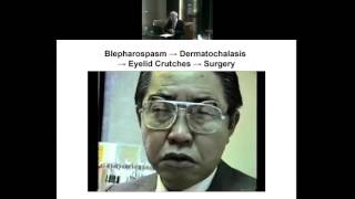 Medical and Complementary Treatment Approaches to Blepharospasm [upl. by Namyw584]