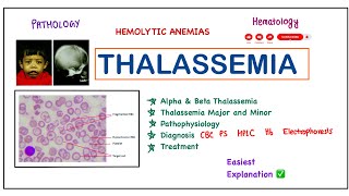 Thalassemia  AlphaBetamajorminor  PathophysiologyDiagnosisTreatment pathology robbins [upl. by Goran]