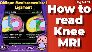 Fig 1A17 Oblique meniscomeniscal ligament [upl. by Julide932]