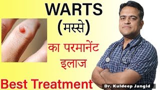 WARTS Best Treatment  मस्से का परमानेंट इलाज  Warts Homeopathic Treatment [upl. by Ysle]