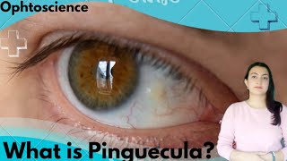 What is Pinguecula symptoms causes and treatment [upl. by Hegyera]