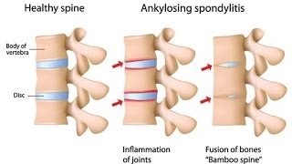 Ankylosing Spondylitis [upl. by Wager816]