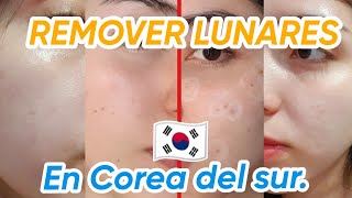 REMOVÍ MAS DE 15 LUNARES FACIALES EN COREA meseoul  Nicolisa [upl. by Halladba925]