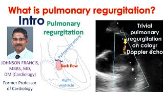 What is pulmonary regurgitation  Intro [upl. by Iris]