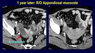 Appendiceal mucocele or mucinous neoplasm  Naming determines the management [upl. by Elijah]