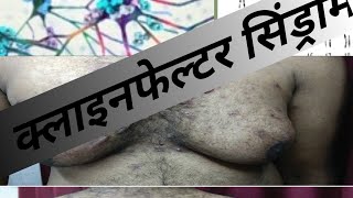 klinefelter syndrome  klinefelter syndrome in hindi class 12 biology  क्लाइनफेल्टर सिंड्रोम [upl. by Akinoj]