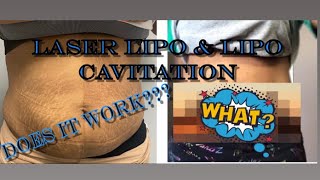 Laser Lipo and lipo cavitation Before amp After Did it work [upl. by Neiviv273]