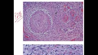 image polyarteritis nodosa  Pathology [upl. by Ainyt]