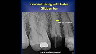 Simple steps to remove separated instruments from a root canal [upl. by Inat]