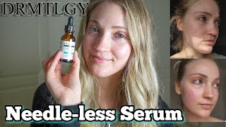 Drmtlgy Needleless Serum Review On AcneProne Skin  Benefits How To Use  Before amp After Pictures [upl. by Ruben488]