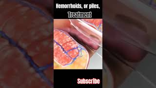 Hemorrhoids or piles surgery and treatment 3danimation viral short [upl. by Fanchan]