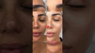 Step by Step Facial at home  Neud Diamond Facial kit ashortaday skincare trending [upl. by Christianna]