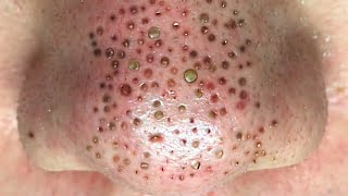 Big Cystic Acne Blackheads Extraction Blackheads amp Milia Whiteheads Removal Pimple Popping [upl. by Wanfried171]