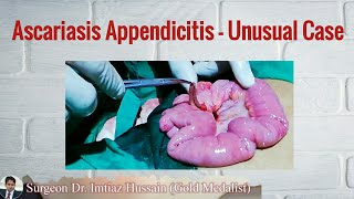 Unusaul Case of Ascariasis Appendicitis  Surgeon Dr Imtiaz Hussain [upl. by Wain713]