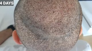 FUE Hair Transplant Timeline  Month 1 to 6  Before amp After [upl. by Hardunn464]