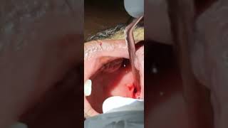 Peritonsillar abscess  Quinsy  Dr Hitesh Patel [upl. by Mettah]