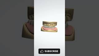 Lower Partial Denture partialdenture dentalprosthesis [upl. by Cordie529]