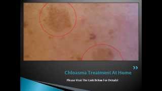 Chloasma Treatment At Home  How to Get Rid of Chloasma or Melasma Naturally [upl. by Aieken]