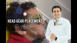 Head gear placement in orthodontics facebow high pullactivator in class II skeletal Dr Amr Asker [upl. by Frick]