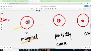 ANTEPARTUM HAEMORRHAGE DISCUSSION [upl. by Cassie]