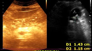 Cholelithiasis  Cholesterol polyp Moderate diffuse fatty Liver  Renal cortical cyst [upl. by Selemas796]