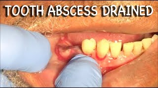 Infected Tooth Abscess Drained  Graphic⚠️ [upl. by Kalinda209]