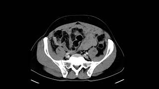 Colon Cancer [upl. by Tepper]