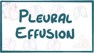 Pleural Effusion  causes symptoms diagnosis treatment pathology [upl. by Dweck107]