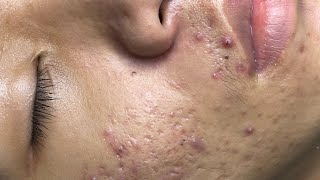 ACNE TREATMENT VU QUYNH MI  Perennial Blackheads On Boy Face 2024 [upl. by Annayr]