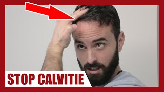 CALVITIE  Comment appliquer correctement le MINOXIDIL afin de la stopper [upl. by Rico424]