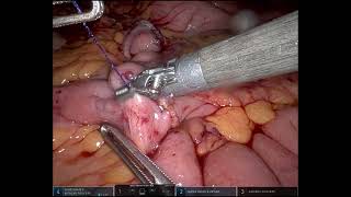 Robotic ileocolic intracorporeal anastomosis  Unedited  Right Hemicolectomy [upl. by Mcilroy]