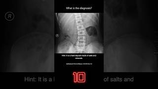 Abdominal Xray Question 12 [upl. by Forelli478]