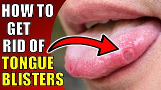 How to Get Rid of Tongue BlistersCanker Sores TOP TEN REMEDIES FOR TONGUE ULCERS [upl. by Haeckel]