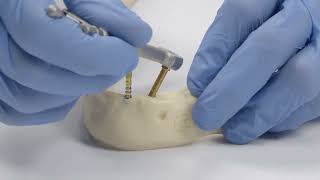 How to  Hands on using Angled Mini Conical Abutments [upl. by Freeman]