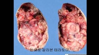 인체의 신비 테라토마약혐주의mystery of teratoma [upl. by Pratte497]