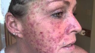 Skin Cancer My VlogJournal Treatment W EFUDEX vid9 [upl. by Alet873]