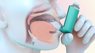 How to Use a MeteredDose Inhaler [upl. by Neyud487]