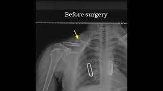 Clavicle Fracture Xray Before After Surgery [upl. by Grove]