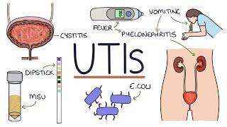 Understanding Urinary Tract Infections [upl. by Kentigera]